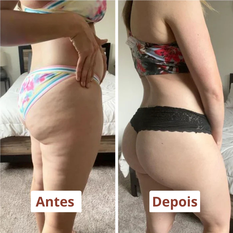 Lymfedrainage massageroller voor lipoedeem en cellulite