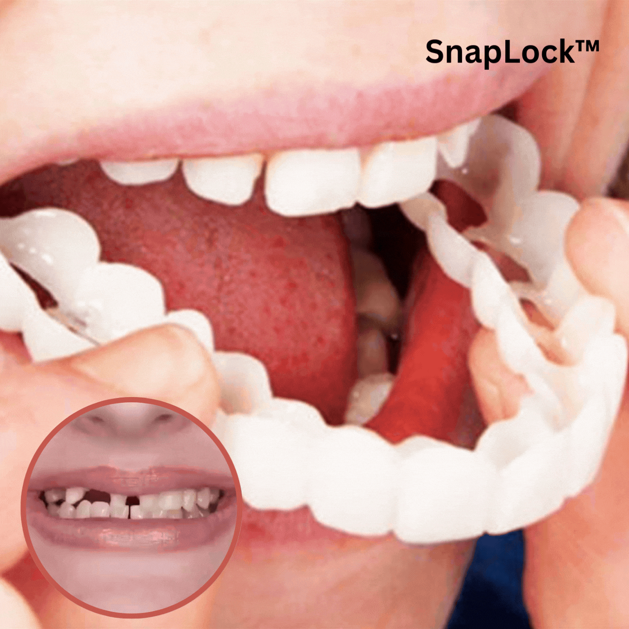 SnapLock Gebitsprothese | Stevige en comfortabele pasvorm voor je glimlach